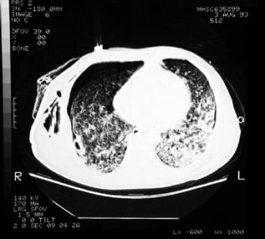 A patient on mechanical ventilation because of acu