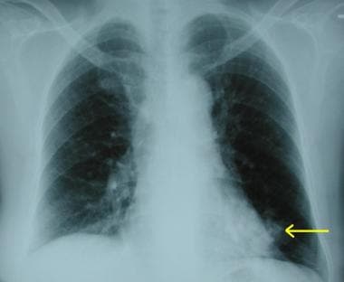 Chest radiograph demonstrating a peripheral opacit