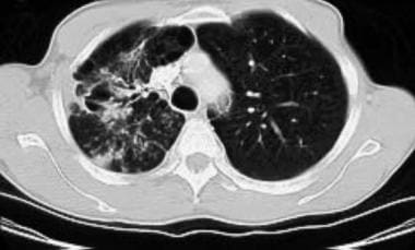 CT chest image in a patient with Mycobacterium kan