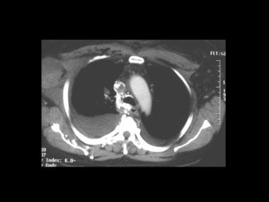 轴位CT扫描显示上腔静脉梗阻