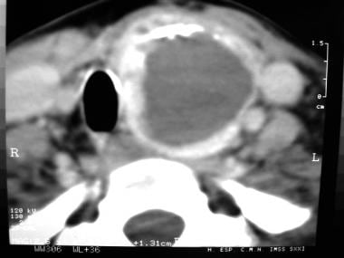 This axial contrast-enhanced computed tomography s