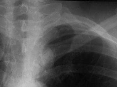 Solitary pulmonary nodule. Close-up view highlight