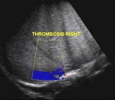 Budd-Chiari syndrome: Two ultrasound images from a