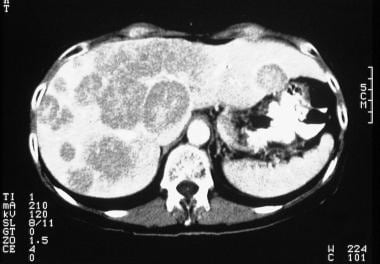 Liver, metastases. Characteristic appearance of ca