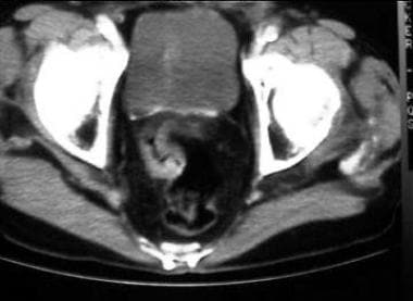 CT scan of wall thickening in a rectal carcinoma. 