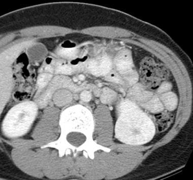 Contrast-enhanced computed tomography (CT) scan of