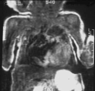 Coronal T1-weighted cardiac-gated MRI in the same 