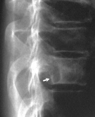 Lateral view of the thoracic spine in a 56-year-ol