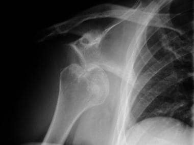 Anteroposterior radiograph of the right shoulder s