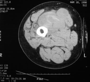 Computed tomography scan of the thigh in a 45-year