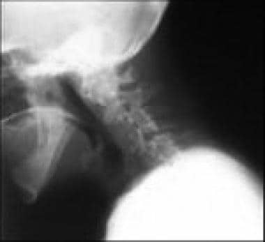 abnormal cervical spine xray