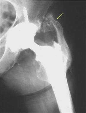 Image from a patient who had a total hip arthropla