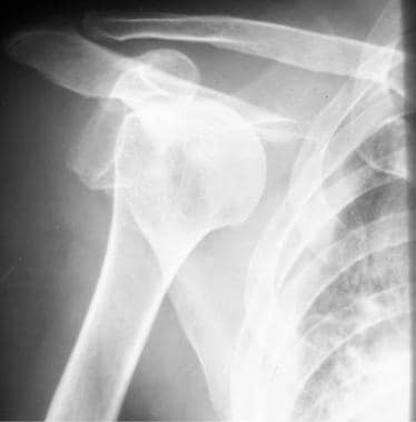 Radiography: Anterior dislocation. 