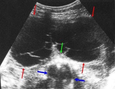 Ultrasonogram shows a massive posterior cystic hyg