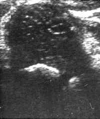 Real-time sonogram of the right hip obtained with 