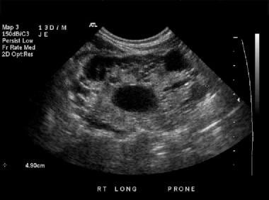 A Longitudinal sonogram of the right kidney shows 