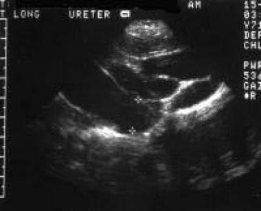 In prune belly syndrome, an abdominal sonogram usu