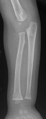 An 18-month-old child with buckle-type distal hume