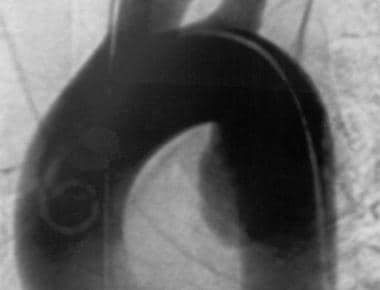 Aorta, trauma. Posteroanterior (PA) angiogram show
