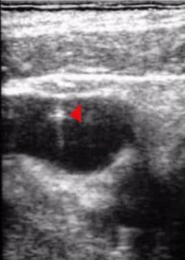 Note the bright echogenic tip of the micropuncture