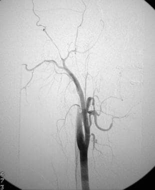 Digital subtraction angiogram of cervical right ca