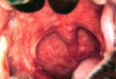 lingual tonsil cancer symptoms