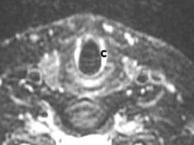 MR imaging, larynx. Image 2 of 3. Axial slice (sli