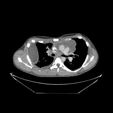 Axial CT image of a 19-year-old adolescent with Lu