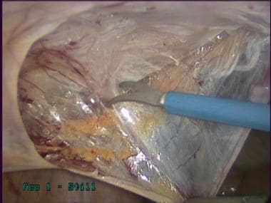 Laparoscopic inguinal hernia repair: TAPP. Sharp d