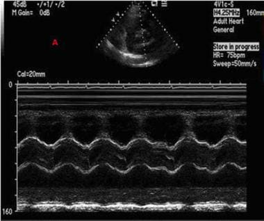 Echocardiography. This is an M-mode image across t
