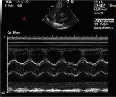 Echocardiography Tutorial - Echocardiographic Modes