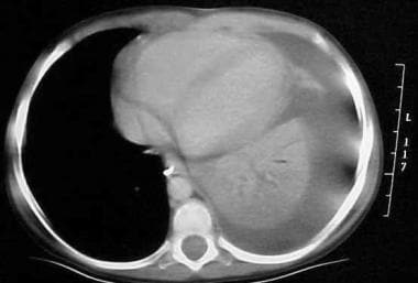 CT scan of the chest in a 3-year-old child with dy