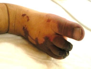 Distal right-foot ischemia with fingertip gangrene