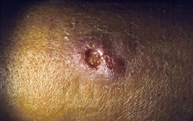 Ulcer on the arm of a patient with primary cutaneo