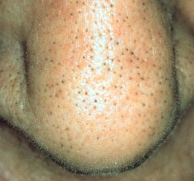 Small, dark, follicular papules on the nose. 
