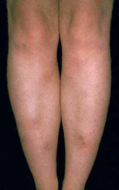 erythema nodosum legs