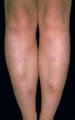 Erythema Nodosum