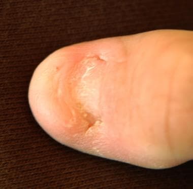 Nail of a patient with nail-patella syndrome. 