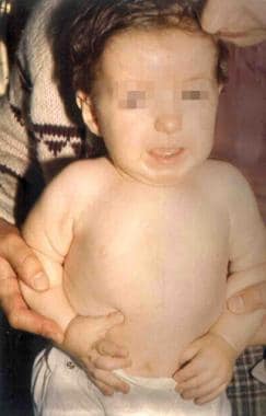 Dermatologic Manifestations of Rubinstein-Taybi Syndrome Clinical  Presentation: History, Physical Examination, Complications