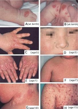 Images show the progression of lesions. A and B: A