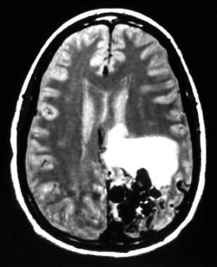 Axial T2 MRI showing an arteriovenous malformation