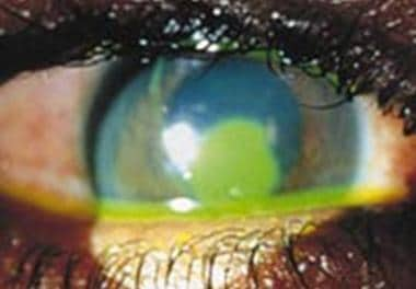 Corneal abrasion. 