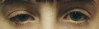 Congenital ptosis on right. Note the presence of a