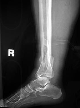 Lateral radiograph of pilon fracture. 
