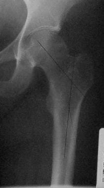 Osteonecrosis localized to a small area of the wei