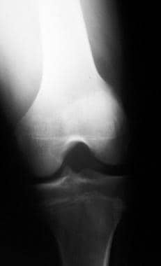 Knee radiograph of 17-year-old athlete with a disc
