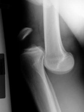 knee patellar dislocation x ray