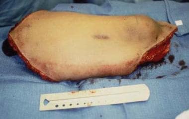 Resected specimen of a proximal tibia osteosarcoma