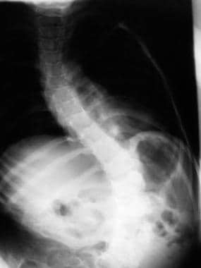 Spinal muscle atrophy. By age 6 years, child's cur