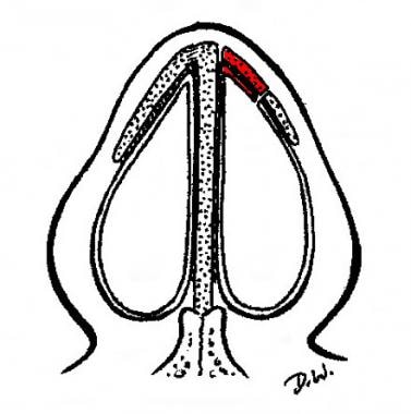 Diagram of composite spreader graft placement in b